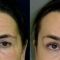 Forehead lift (Brow lift)