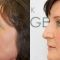 Eyelid surgery (Blepharoplasty)