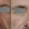 Injections de comblement