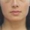 Lip augmentation - cheiloplasty