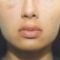Lip augmentation - cheiloplasty