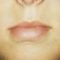 Lip augmentation - cheiloplasty