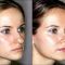 Operácia nosa (Rhinoplastika)