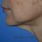 Lifting du visage