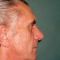 Rhinoplasty (Nose Job)