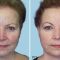 Facelift (operace obličeje), SMAS lifting