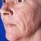 Fractional Laser Resurfacing