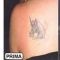 Rimozione tatuaggi - laser