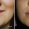 Augmentation des lèvres par Permalip