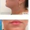 Liposuccion
