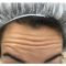 Botulinum toxin - Wrinkle Removal