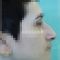 Operácia nosa (Rhinoplastika)