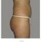 Liposukcia