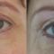 Korekcja brwi (Brow lift)
