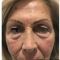 Blépharoplastie inférieure