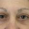 Eyelid surgery (Blepharoplasty)