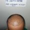 Hair Transplant