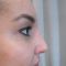 Rhinoplastie médicale