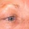 Operácia očných viečok (Blepharoplastika)