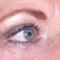 Operácia očných viečok (Blepharoplastika)