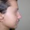 Operácia nosa (Rhinoplastika)