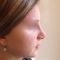 Operácia nosa (Rhinoplastika)