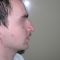 Operácia nosa (Rhinoplastika)