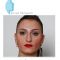 Rhinoplastie