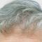 Haartransplantation