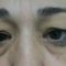 Blépharoplastie