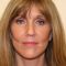 Facelift, SMAS facelifting