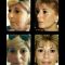 Lifting du visage
