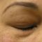 Hydradermabraze