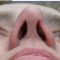 Operácia nosa (Rhinoplastika)