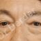 Blépharoplastie inférieure