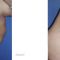 Liposuccion