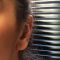 Otoplastie (Chirurgie esthétique des oreilles)