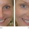 Botulinum toxin - Wrinkle Removal