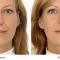 Botulinum toxin - Wrinkle Removal