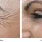 Botulinum toxin - Wrinkle Removal