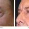 Eyelid surgery (Blepharoplasty)