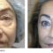 Eyelid surgery (Blepharoplasty)