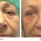 Eyelid surgery (Blepharoplasty)