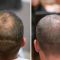 Greffe de cheveux