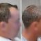 Greffe de cheveux