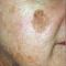 Procedure laser in dermatologia estetica