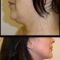 Liposuction