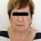 Facelift (operace obličeje), SMAS lifting