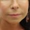 BOTOX®