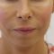 BOTOX®